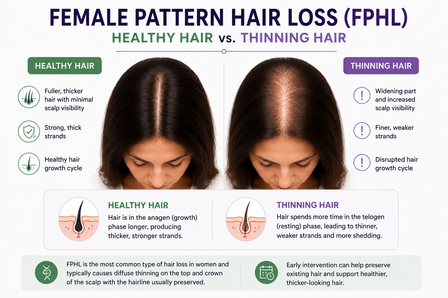 Female pattern hair loss showing the difference between healthy hair and diffuse thinning along the top and crown of the scalp.